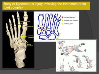 Bony or ligamentous injury involving the tarsometatarsal
joint complex
 