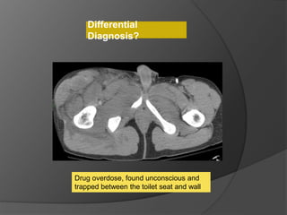 Drug overdose, found unconscious and
trapped between the toilet seat and wall
Differential
Diagnosis?
 