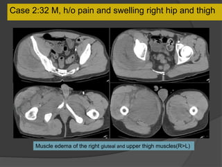 Case 2:32 M, h/o pain and swelling right hip and thigh
Muscle edema of the right gluteal and upper thigh muscles(R>L)
 