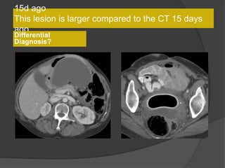 15d ago
This lesion is larger compared to the CT 15 days
ago
Differential
Diagnosis?
 