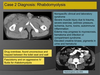 Case 2 Diagnosis: Rhabdomyolysis
Nonspecific clinical and laboratory
syndrome
Severe muscle injury due to trauma,
severe exercise, extrinsic pressure,
ischemia, burns, toxins, autoimmune
inflammation
Edema may progress to myonecrosis,
hematoma and infection or
compartment syndrome.
Elevated creatine kinase, pigments in
urine and hematuria
Fasciotomy and on aggressive IV
fluids for rhabdomyolysis
Drug overdose, found unconscious and
trapped between the toilet seat and wall
RadioGraphics July 2004
 