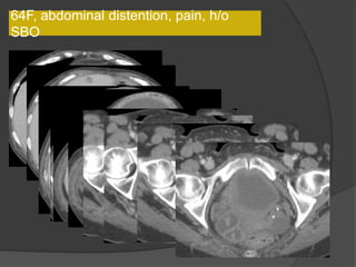 64F, abdominal distention, pain, h/o
SBO
 