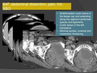 64F, abdominal distention, pain, h/o
SBO
• Multilobulated cystic lesion in
the lesser sac and extending
along the adjacent peritoneal
spaces and ligaments
• Cystic lesion in the left
hemipelvis
• Minimal ascites, omental and
mesenteric thickening
 