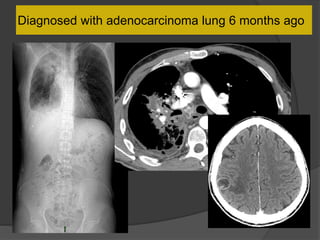 Diagnosed with adenocarcinoma lung 6 months ago
 