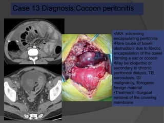 Case 13 Diagnosis:Cocoon peritonitis
•AKA sclerosing
encapsulating peritonitis
•Rare cause of bowel
obstruction due to fibrotic
encapsulation of the bowel
forming a sac or cocoon
•May be idiopathic or
secondary to chronic
peritoneal dialysis, TB,
sarcoidosis, GI
malignancy, fibrogenic
foreign material
•Treatment –Surgical
removal of the covering
membrane
 
