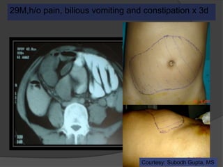 29M,h/o pain, bilious vomiting and constipation x 3d
Courtesy: Subodh Gupta, MS
 