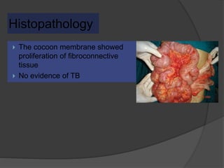 Histopathology
 The cocoon membrane showed
proliferation of fibroconnective
tissue
 No evidence of TB
 