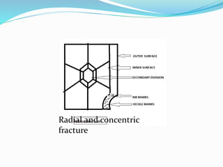 Radial and concentric
fracture
 