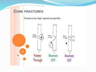 Radial and concentric
fracture
 