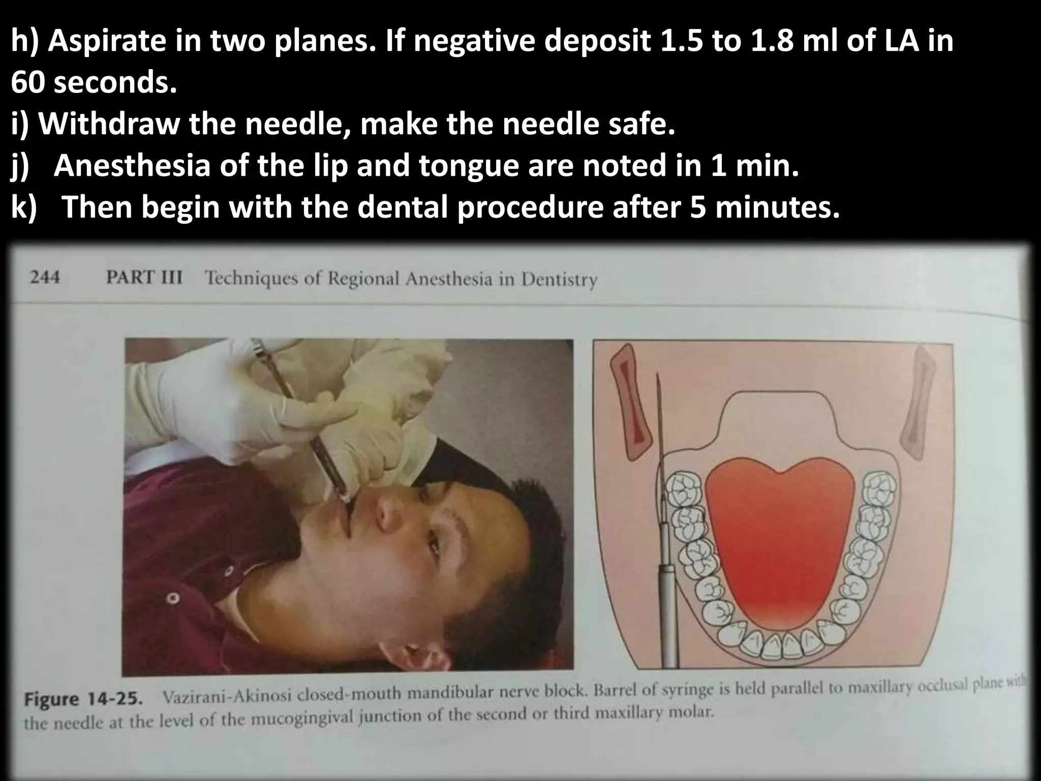 MANDIBULAR NERVE BLOCK. PPT