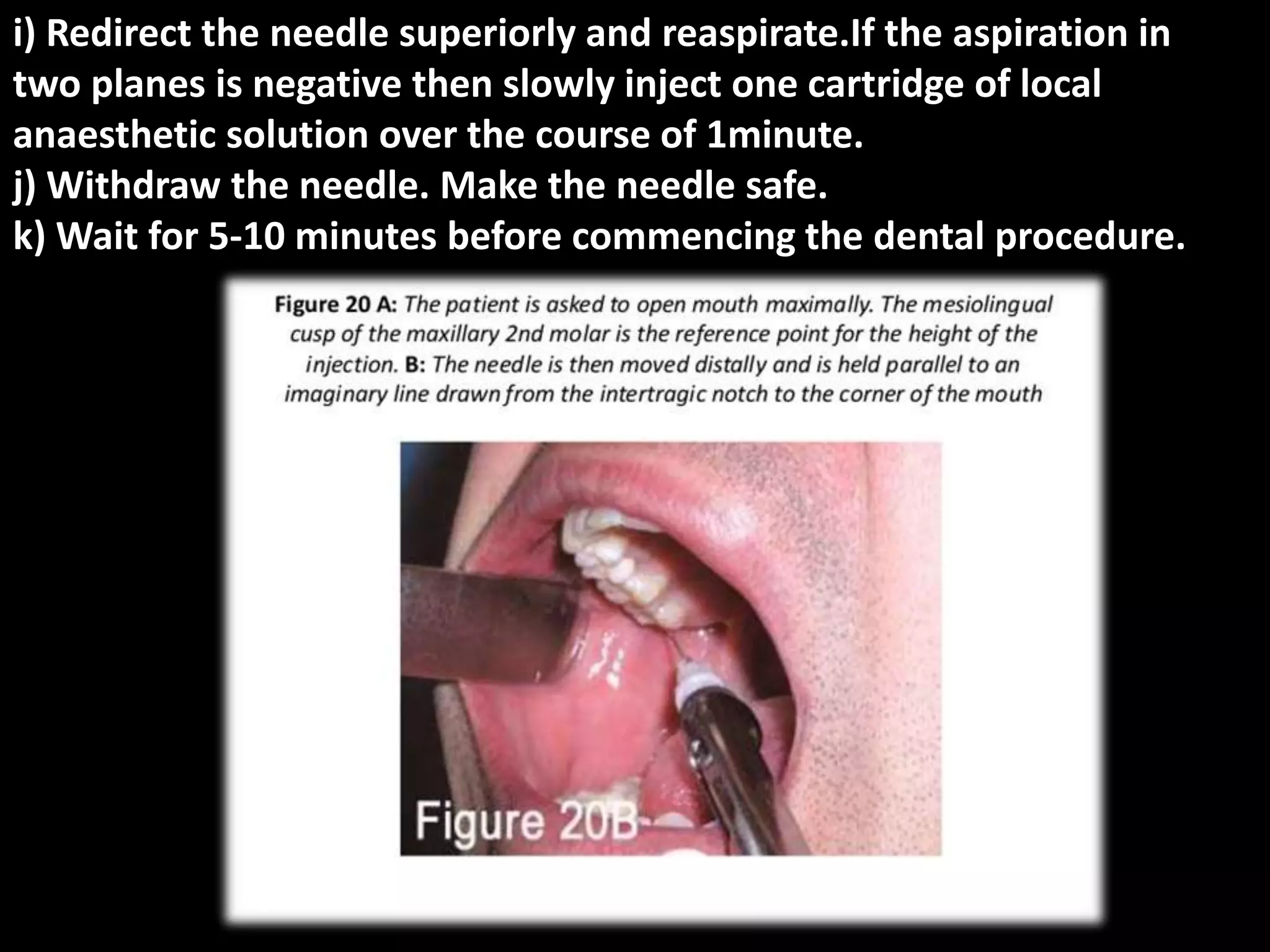 MANDIBULAR NERVE BLOCK. PPT