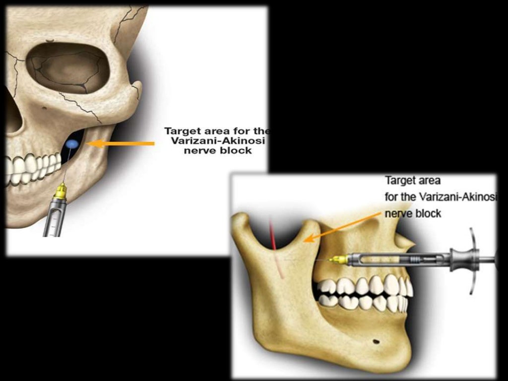 MANDIBULAR NERVE BLOCK.