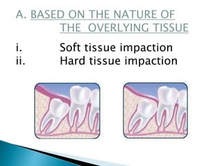 A. BASED ON THE NATURE OF
THE OVERLYING TISSUE
i. Soft tissue impaction
ii. Hard tissue impaction
 