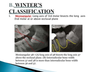 I. Mesioangular: Long axis of 3rd molar bisects the long axis
2nd molar at or above occlusal plane
Mesioangular 38—(A) long axis of 38 bisects the long axis 37
above the occlusal plane. (B) Interradicular bone width
between 37 and 38 is more than interradicular bone width
between 36 and 37.
 
