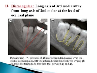Distoangular—(A) long axis of 48 is away from long axis of 47 at the
level of occlusal plane. (B) The interradicular bone between 47 and 48
is almost obliterated and less than that between 46 and 47.
 