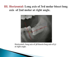 Horizontal—long axis of 38 bisects long axis of 37
at right angle.
 