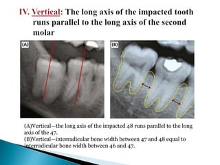 (A)Vertical—the long axis of the impacted 48 runs parallel to the long
axis of the 47.
(B)Vertical—interradicular bone width between 47 and 48 equal to
interradicular bone width between 46 and 47.
 
