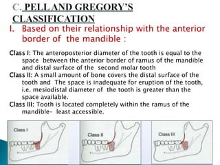 I. Based on their relationship with the anterior
border of the mandible :
Class I: The anteroposterior diameter of the tooth is equal to the
space between the anterior border of ramus of the mandible
and distal surface of the second molar tooth
Class II: A small amount of bone covers the distal surface of the
tooth and The space is inadequate for eruption of the tooth,
i.e. mesiodistal diameter of the tooth is greater than the
space available.
Class III: Tooth is located completely within the ramus of the
mandible– least accessible.
 