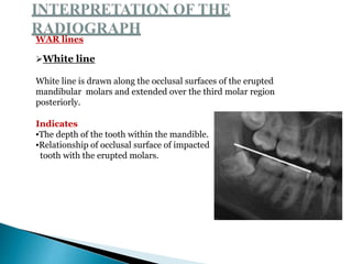 WAR lines
White line
White line is drawn along the occlusal surfaces of the erupted
mandibular molars and extended over the third molar region
posteriorly.
Indicates
▪The depth of the tooth within the mandible.
▪Relationship of occlusal surface of impacted
tooth with the erupted molars.
 