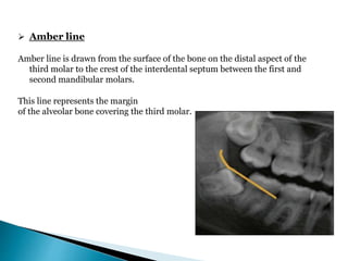  Amber line
Amber line is drawn from the surface of the bone on the distal aspect of the
third molar to the crest of the interdental septum between the first and
second mandibular molars.
This line represents the margin
of the alveolar bone covering the third molar.
 
