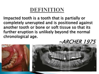 Impacted tooth is a tooth that is partially or
completely unerupted and is positioned against
another tooth or bone or soft tissue so that its
further eruption is unlikely beyond the normal
chronological age.
~ARCHER 1975
 