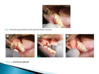 Step 4: Incisions placed
 
