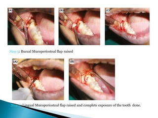 Step 5: Buccal Mucoperiosteal flap raised
Step 6: Lingual Mucoperiosteal flap raised and complete exposure of the tooth done.
 