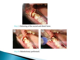 Step 7: Guttering of the mesial and distal bone.
Step 8: Odontectomy performed.
 