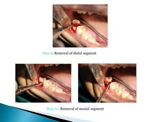 Step 10: Removal of mesial segment
Step 9: Removal of distal segment
 