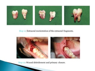 Step 11: Extraoral reorientation of the extraoral fragments.
Step 12: Wound debridement and primary closure.
 