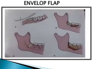 ENVELOP FLAP
 