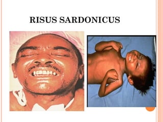RISUS SARDONICUS
www.medicalgeek.com
 