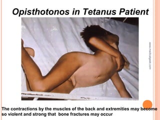 Opisthotonos in Tetanus Patient
The contractions by the muscles of the back and extremities may become
so violent and strong that bone fractures may occur
www.medicalgeek.com
 