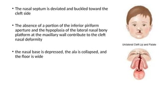 A brief description of anatomy , classification and surgeries in cleft ...