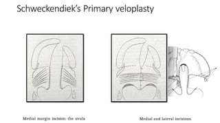 Uvula Incision A brief description of anatomy , classification and surgeries in cleft ...