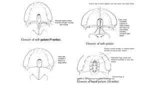 Uvula Incision A brief description of anatomy , classification and surgeries in cleft ...