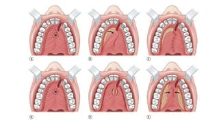 A brief description of anatomy , classification and surgeries in cleft ...