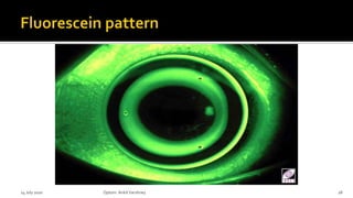 14 July 2020 Optom.AnkitVarshney 28
 