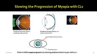 Ortho-k inhibit myopiaprogression byinducingperipheralretinalmyopic defocus*.
Peripheral hyperopic defocus
acceleratesaxial growth
Peripheral myopic defocus can
reduceaxial growth*
Ortho-K
Treatment zone
AreaofPeripheral Myopic Defocus
14 July 2020 Optom.AnkitVarshney 35
 