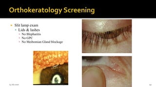  Slit lamp exam
 Lids & lashes
▪ No Blepharitis
▪ No GPC
▪ No Meibomian Gland blockage
14 July 2020 Optom.AnkitVarshney 49
 