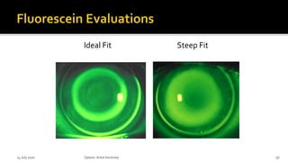 Ideal Fit Steep Fit
14 July 2020 Optom.AnkitVarshney 56
 