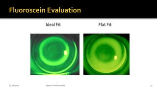 Ideal Fit Flat Fit
14 July 2020 Optom.AnkitVarshney 57
 