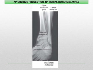 ankle.ppt