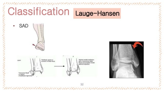 Ankle Fracture By Rgjel