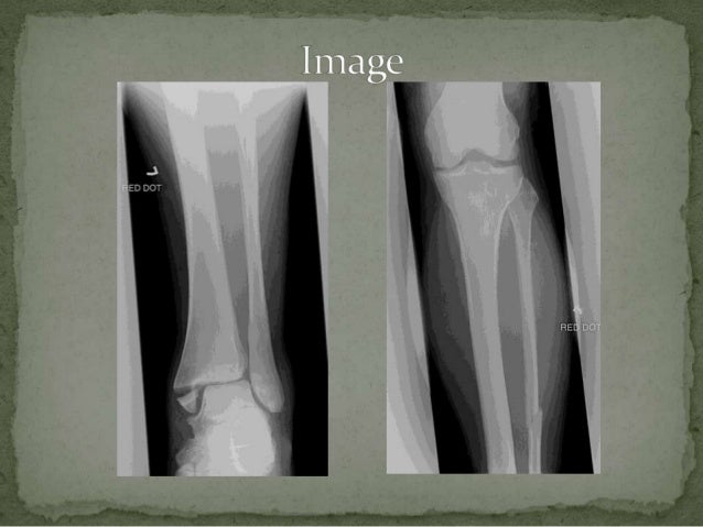 maisonneuve fracture maisonneuve fracture