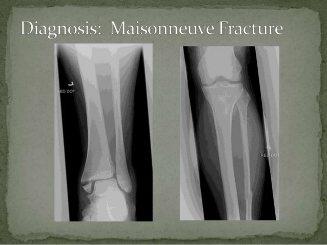 Maisonneuve Fracture Maisonneuve Fracture