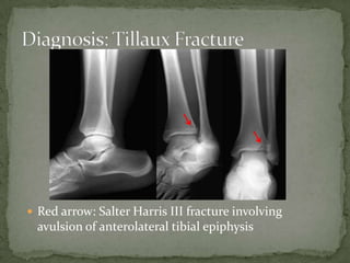  Red arrow: Salter Harris III fracture involving

avulsion of anterolateral tibial epiphysis

 