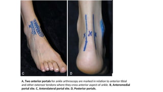 A, Two anterior portals for ankle arthroscopy are marked in relation to anterior tibial
and other extensor tendons where they cross anterior aspect of ankle. B, Anteromedial
portal site. C, Anterolateral portal site. D, Posterior portals.
 