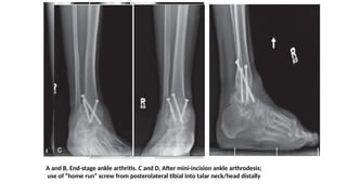 A and B, End-stage ankle arthritis. C and D, After mini-incision ankle arthrodesis;
use of “home run” screw from posterolateral tibial into talar neck/head distally
 