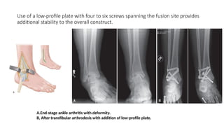 Use of a low-profile plate with four to six screws spanning the fusion site provides
additional stability to the overall construct.
A.End-stage ankle arthritis with deformity.
B, After transfibular arthrodesis with addition of low-profile plate.
 